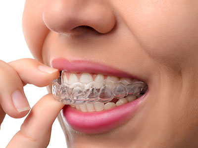Granger Dentistry | Dentures, Teeth Whitening and Orthodontics