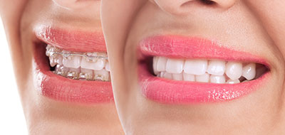 Granger Dentistry | All-on-4 reg , Veneers and Periodontal Treatment
