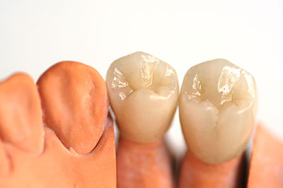 Granger Dentistry | Ceramic Crowns, Night Guards and Dental Bridges